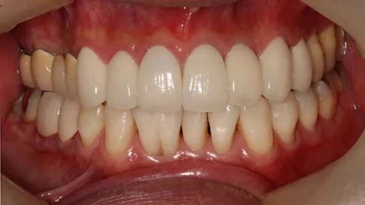 前歯セラミック矯正施術後