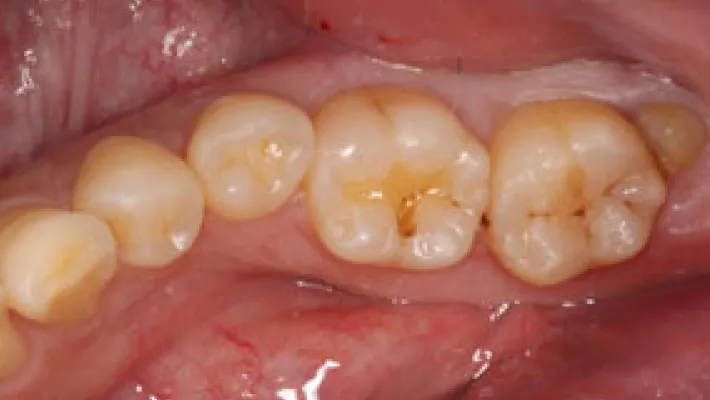奥歯セラミック治療施術前