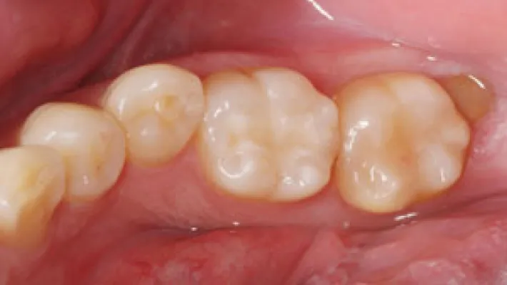 奥歯セラミック治療施術後