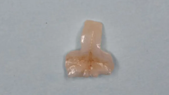 奥歯セラミック治療施術前