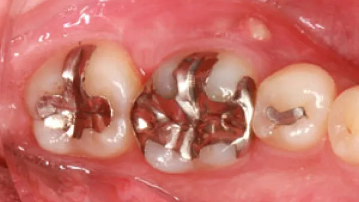 奥歯セラミック治療施術前