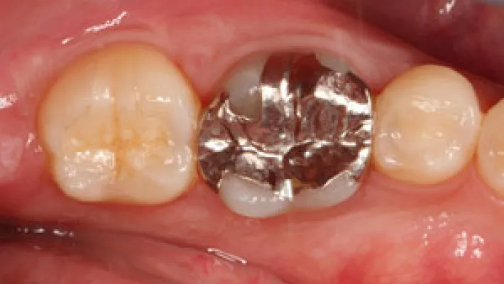 奥歯セラミック治療施術後