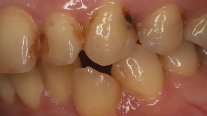 施術前 [左上3（犬歯）1本]