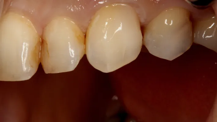 ダイレクトボンディング（自費CR）後