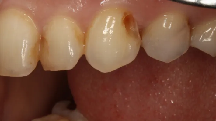 施術後(ホワイトニング)