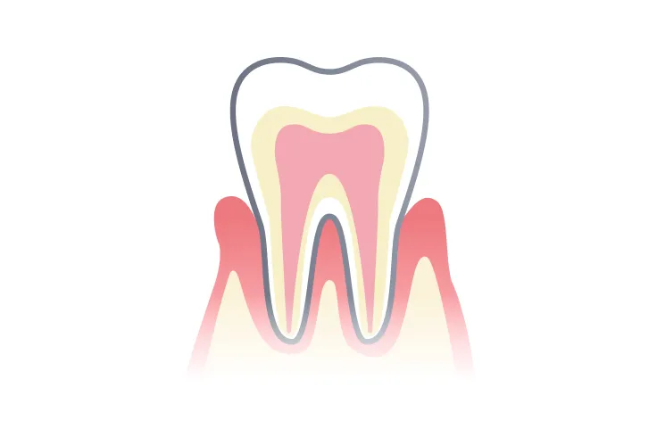 歯肉炎の断面図