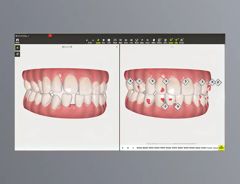 インビザラインGOモデル