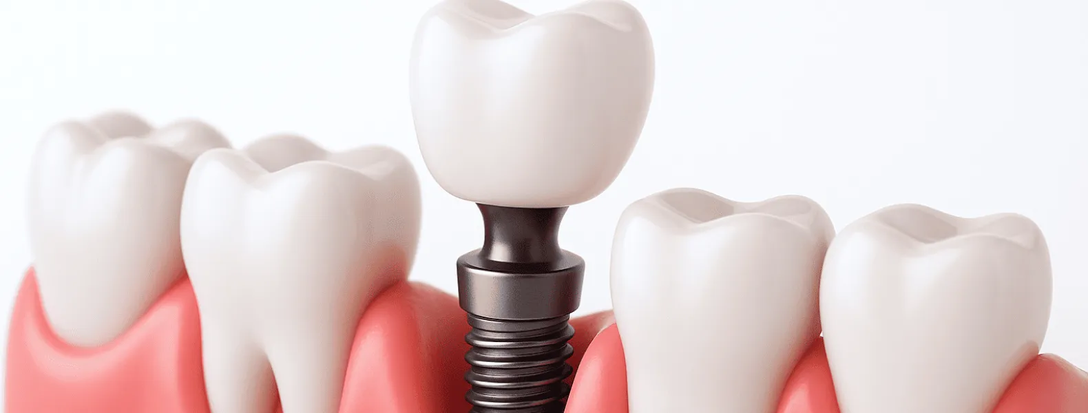 インプラント治療の説明