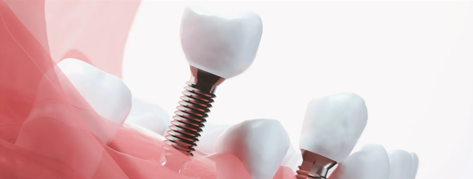 インプラント治療