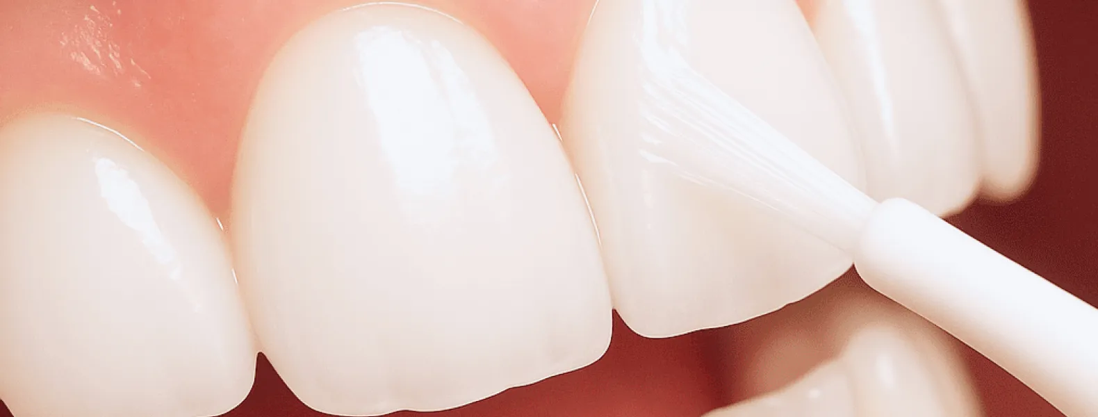 歯のマニキュア