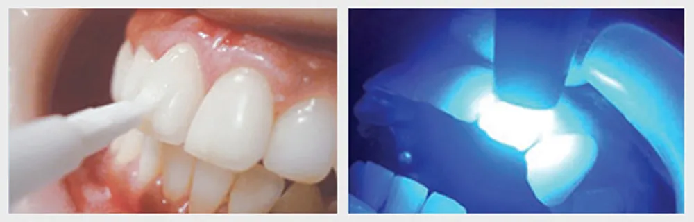 ツヤ出し薬剤とレーザー処置