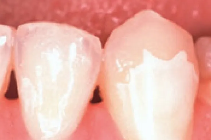 下の歯のマニキュア