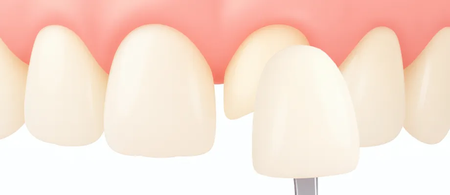 オールセラミック治療