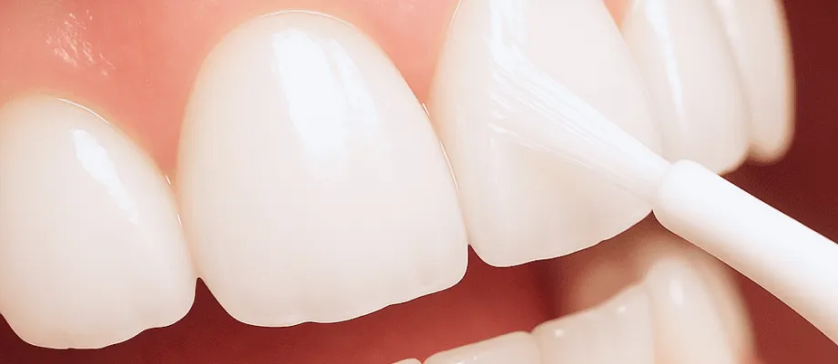 歯のマニキュア