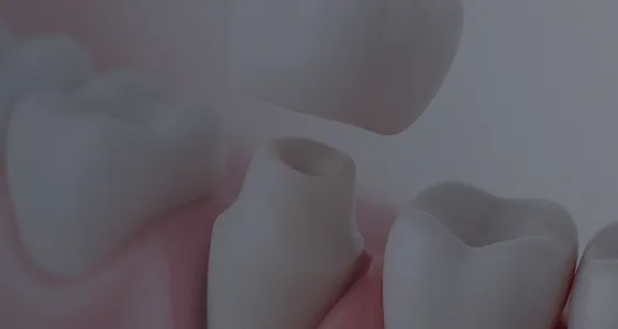 オールセラミック治療