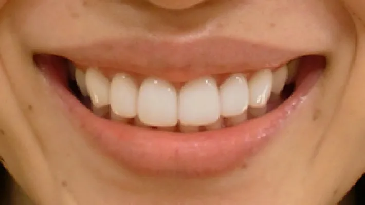 ラミネートベニア施術後