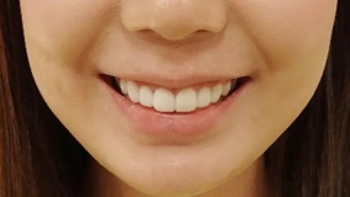 ラミネートベニア施術後