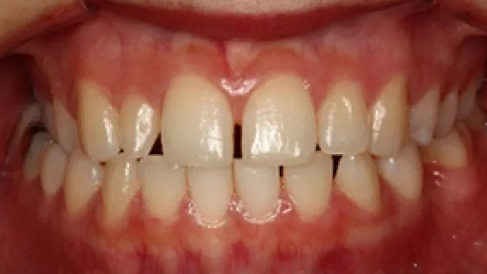 ラミネートベニア施術前