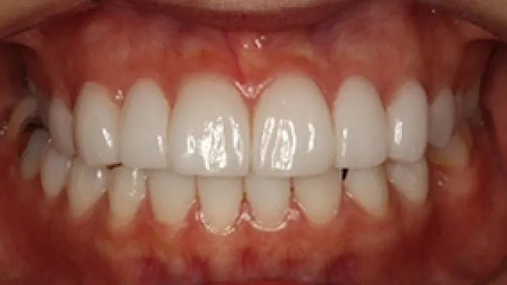 ラミネートベニア施術後