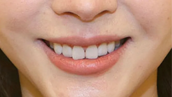 ラミネートベニア施術前