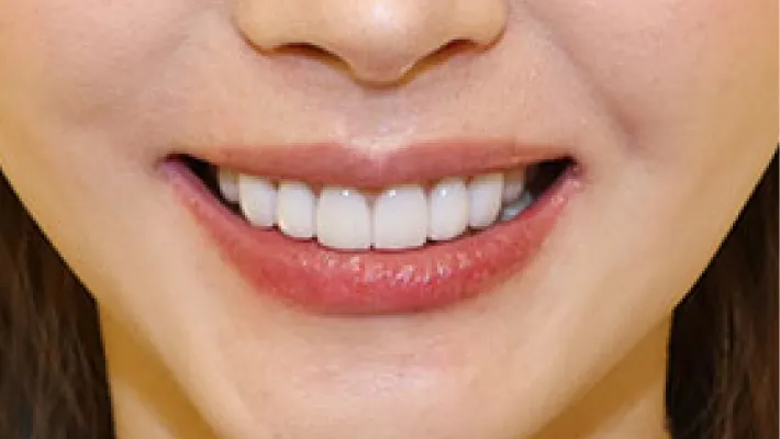 ラミネートベニア施術後