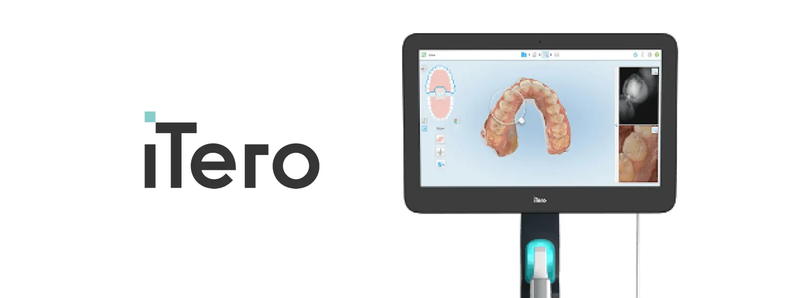 iTero 3Dデジタルスキャナー