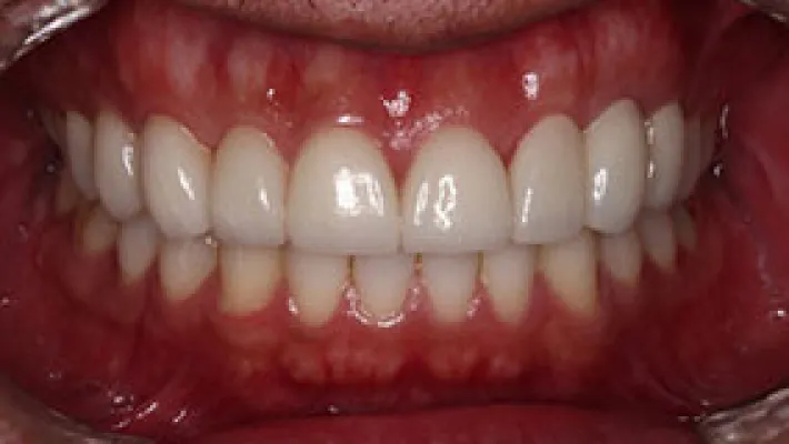オールセラミック施術後1