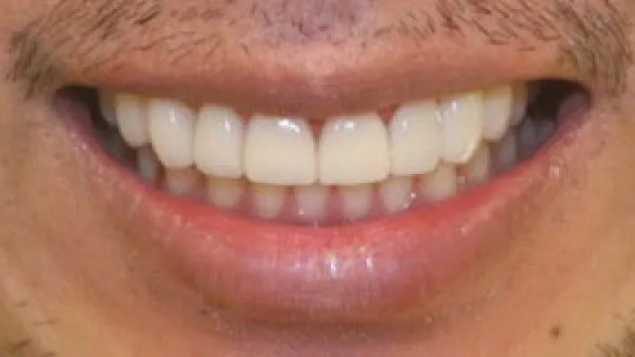 オールセラミック施術後2