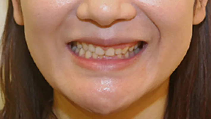 ラミネートベニア+歯肉整形施術前