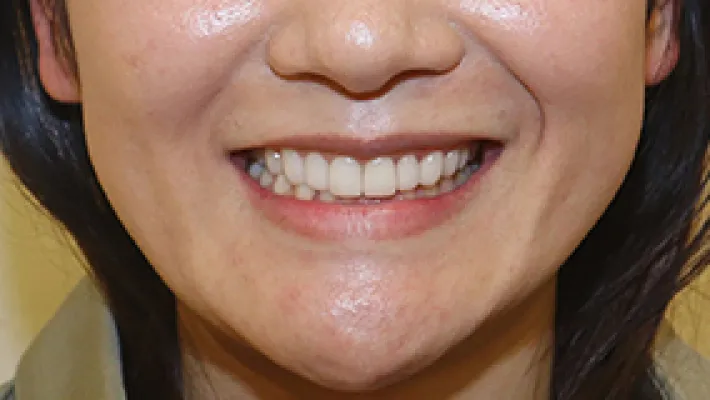ラミネートベニア+歯肉整形施術後