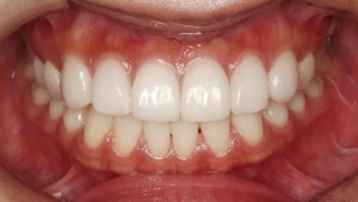 ラミネートベニア施術後1