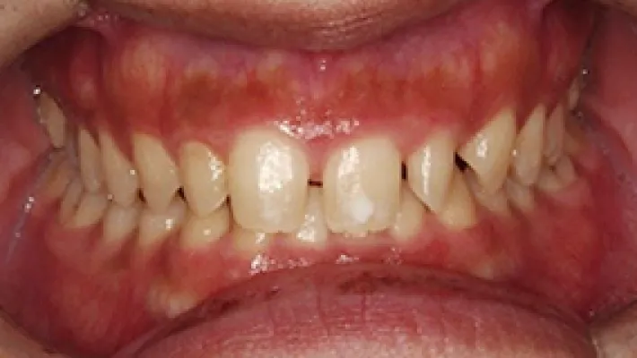 ラミネートベニア施術前1