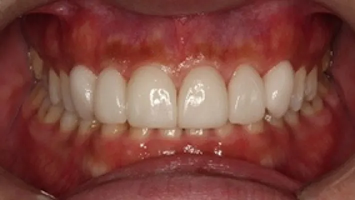 ラミネートベニア施術後1