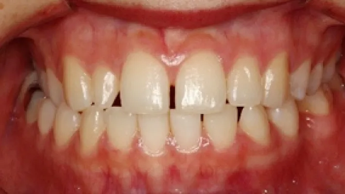 ラミネートベニア施術前