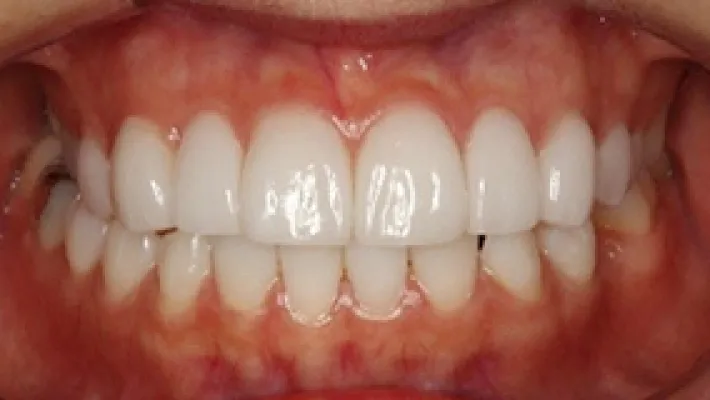 ラミネートベニア施術後