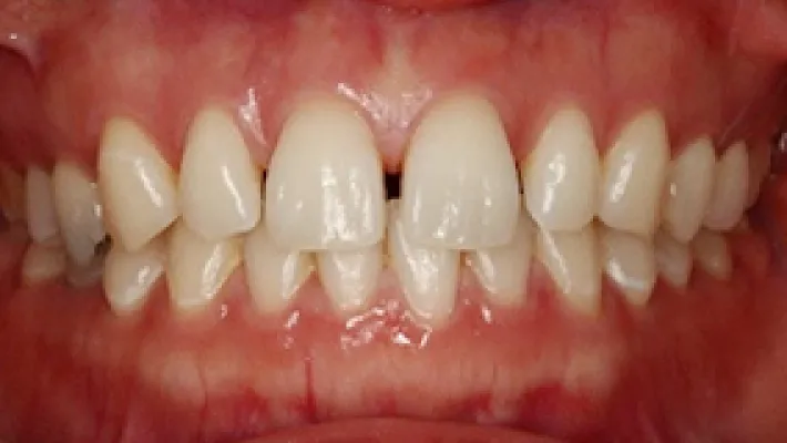 ラミネートベニア施術前