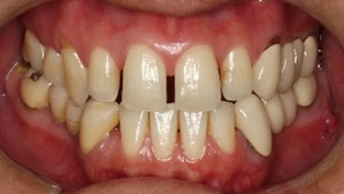 オールセラミック施術前2