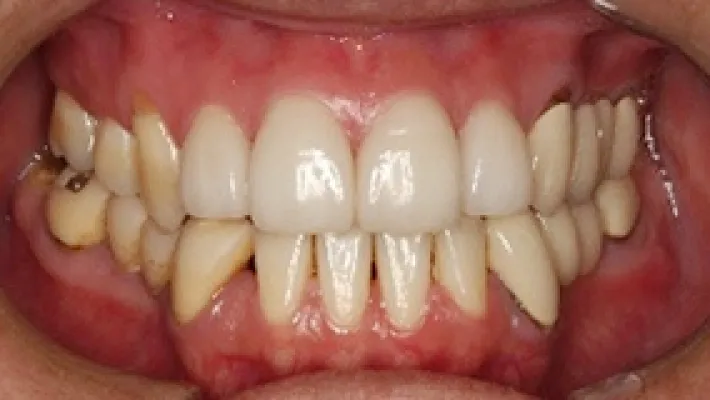 オールセラミック施術後2