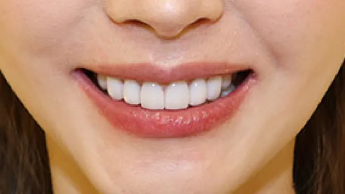 ラミネートベニア施術後