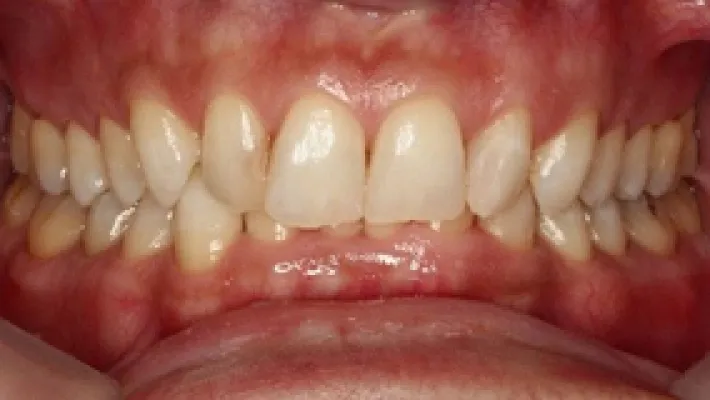 ラミネートベニア施術前