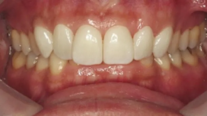 ラミネートベニア施術後