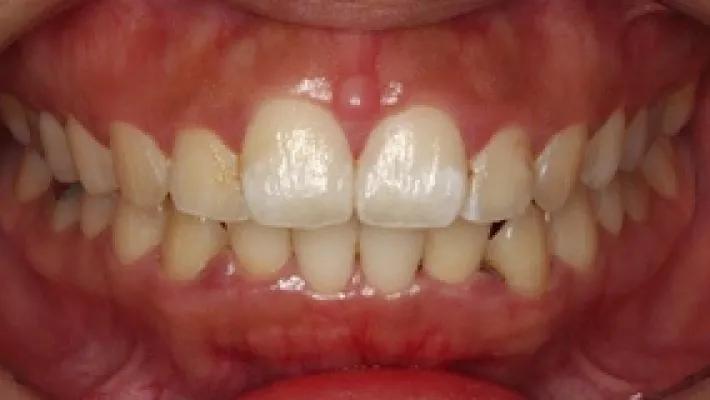 ラミネートベニア施術前