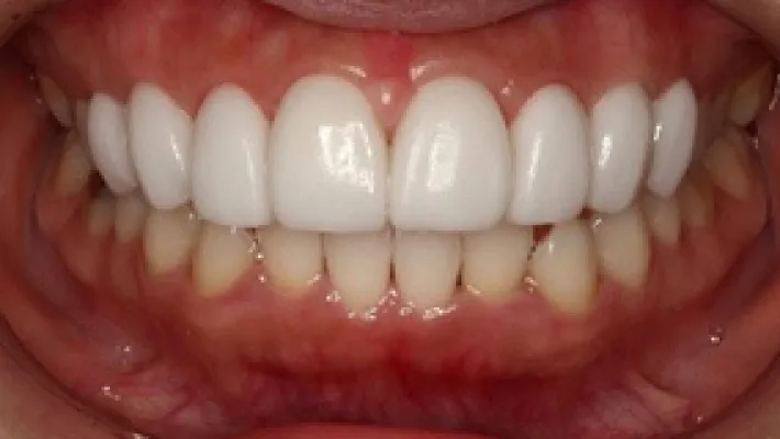 ラミネートベニア施術後