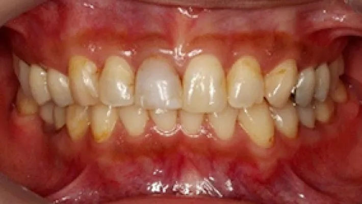 ラミネートベニア施術前1