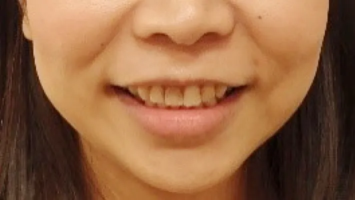 ラミネートベニア施術前2