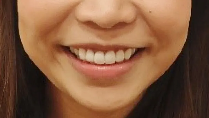 ラミネートベニア施術後2