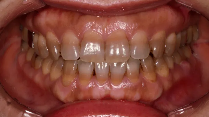 テトラサイクリン歯施術前