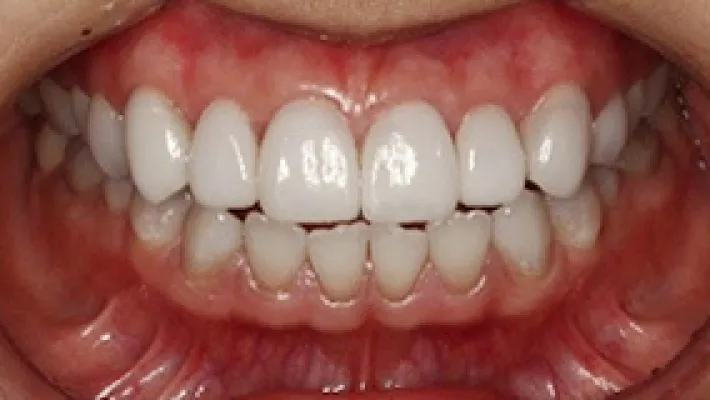 テトラサイクリン歯施術後1