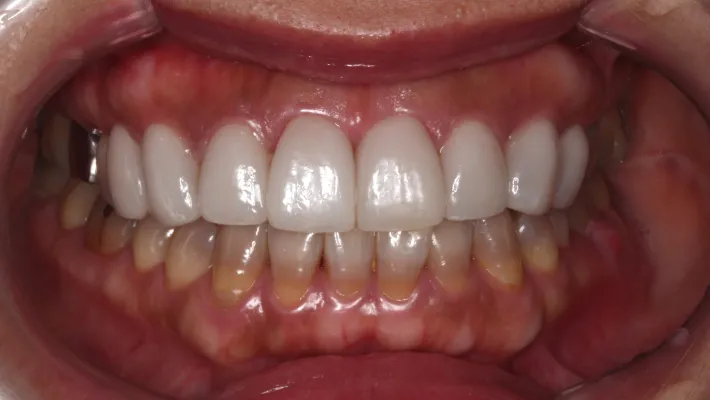 テトラサイクリン歯施術後