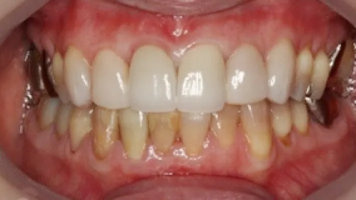 テトラサイクリン歯とクラウン施術後